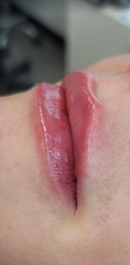 Renewal Aesthetics and Sexual Wellness lip filler after — Draper, UT
