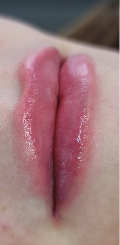 Lip Filler after at Renewal Aesthetics and Sexual Wellness in Draper, UT
