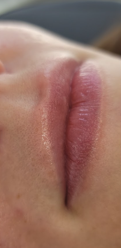 Lip Filler before at Renewal Aesthetics and Sexual Wellness in Draper, UT