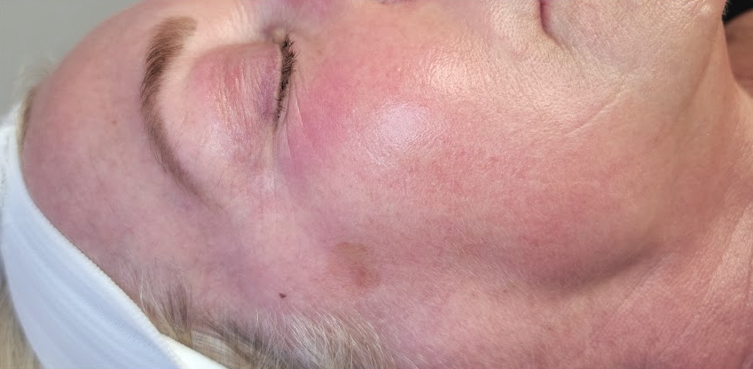 Renewal Aesthetics and Sexual Wellness result — Draper, UT