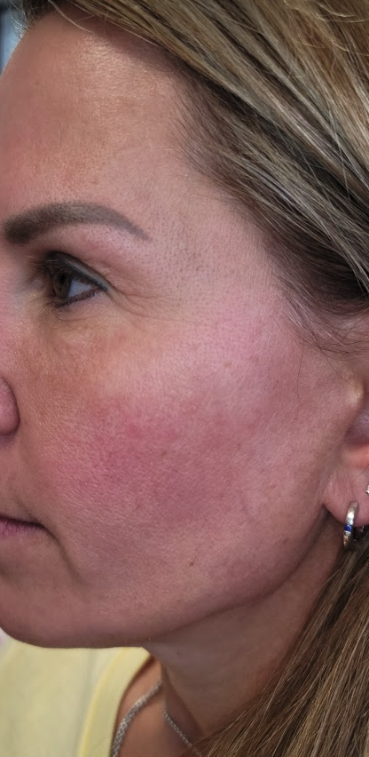 Renewal Aesthetics and Sexual Wellness jawline filler after — Draper, UT