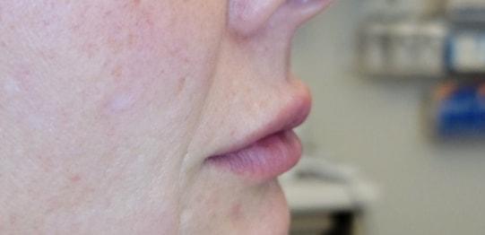Lip Filler before at Renewal Aesthetics and Sexual Wellness in Draper, UT