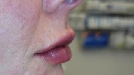 Renewal Aesthetics and Sexual Wellness lip filler after — Draper, UT