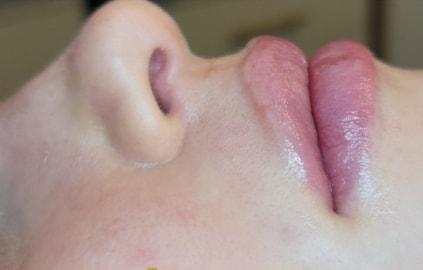 Renewal Aesthetics and Sexual Wellness lip filler after — Draper, UT