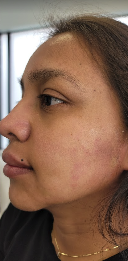 Renewal Aesthetics and Sexual Wellness jawline filler after — Draper, UT