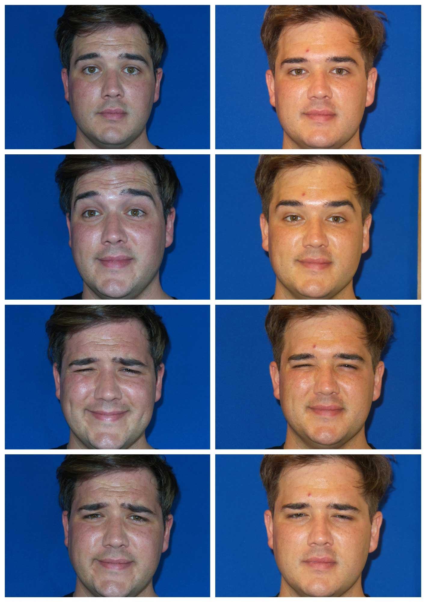 ReFresh Aesthetic Center botox result — Mequon, WI