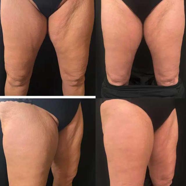 Microneedling result at ReFresh Aesthetic Center in Mequon, WI