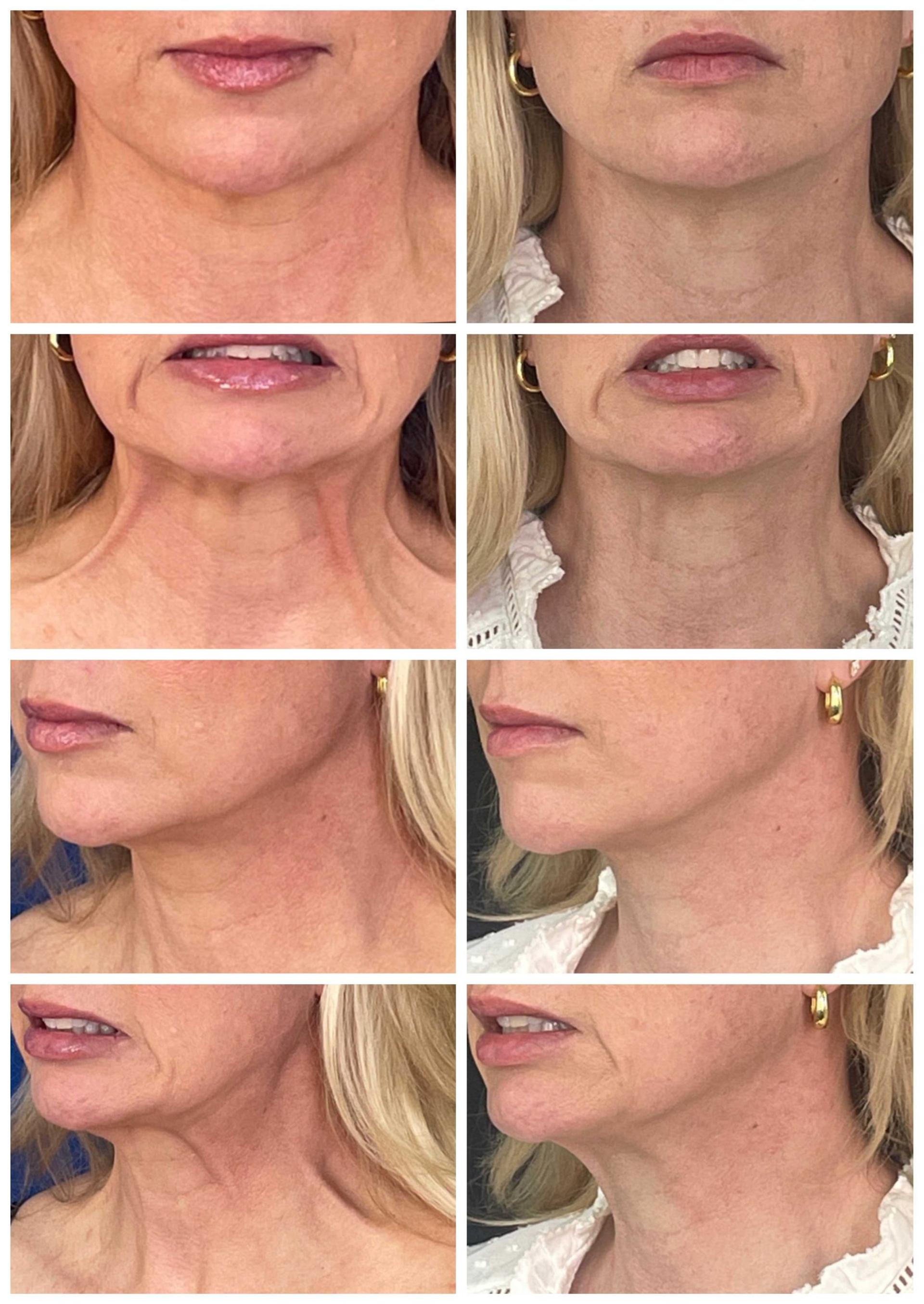 ReFresh Aesthetic Center botox result — Mequon, WI