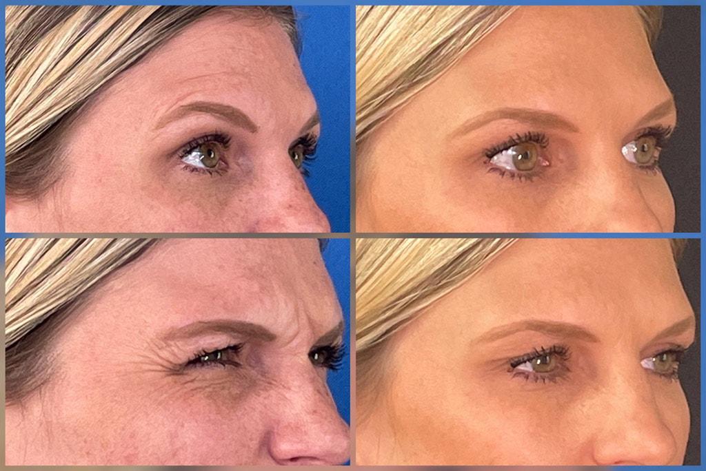 ReFresh Aesthetic Center botox result — Mequon, WI