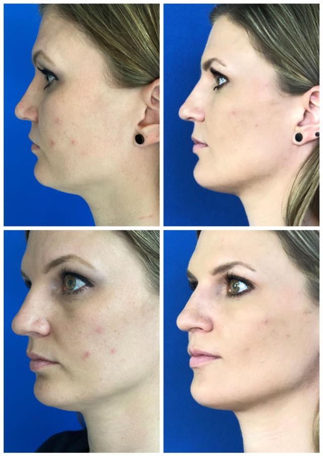 Jawline Filler result at ReFresh Aesthetic Center in Mequon, WI