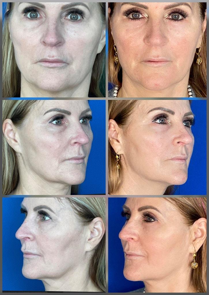 ReFresh Aesthetic Center cheek filler result — Mequon, WI