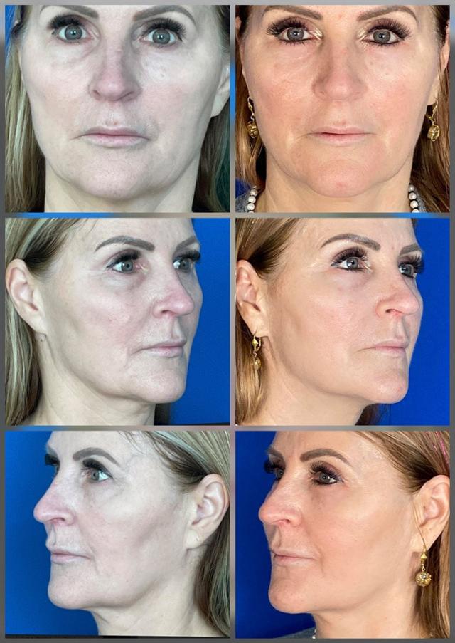 Juvederm result at ReFresh Aesthetic Center in Mequon, WI