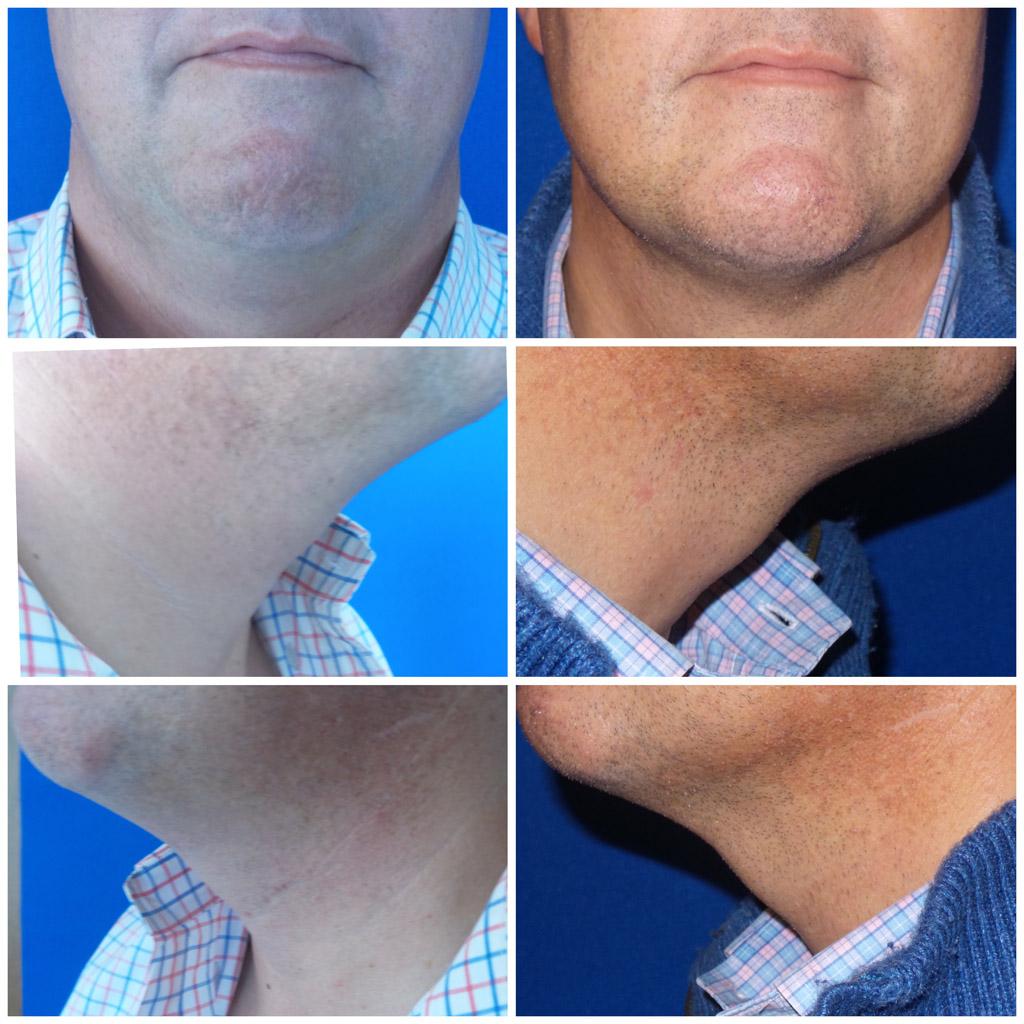 ReFresh Aesthetic Center result — Mequon, WI