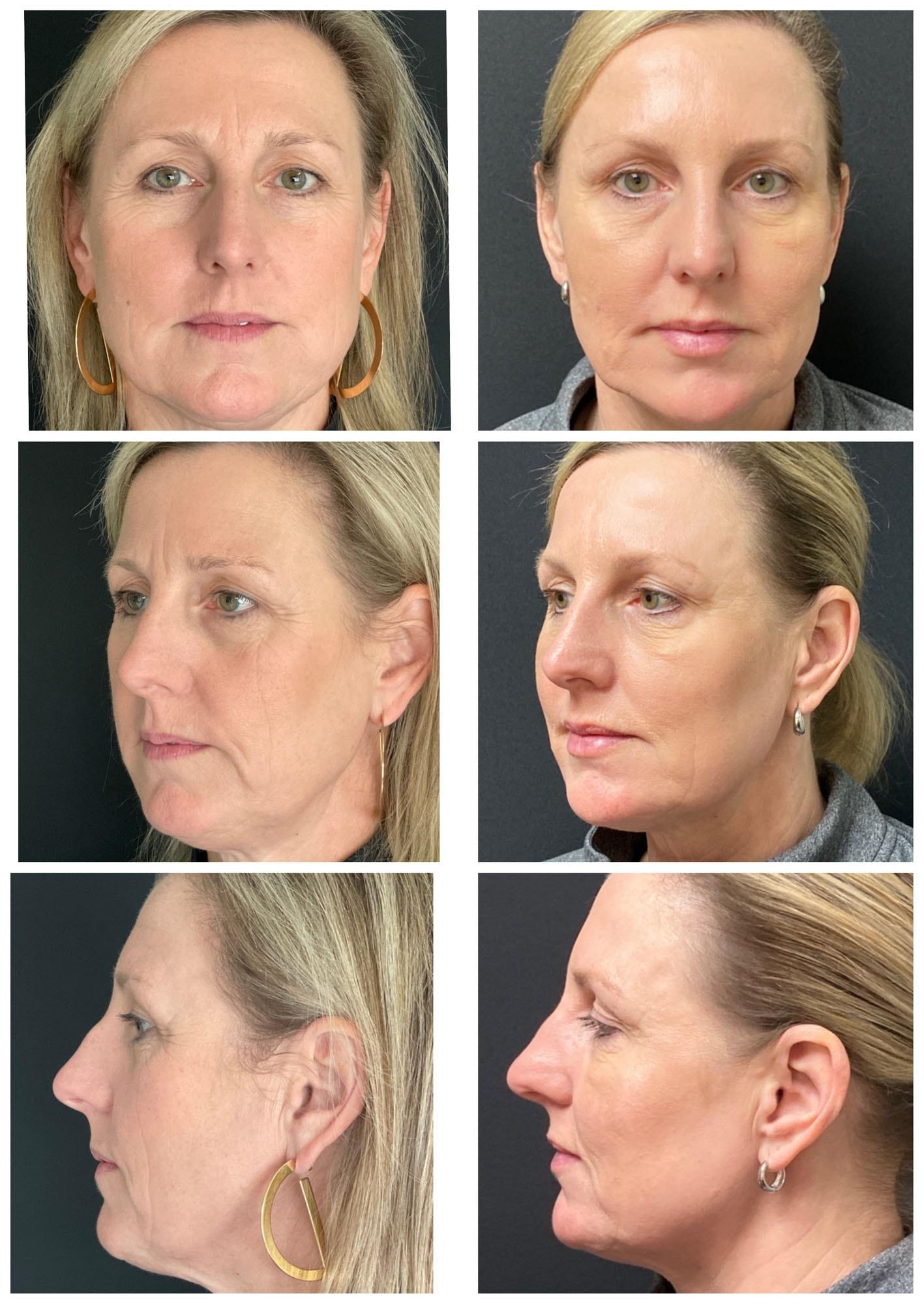 ReFresh Aesthetic Center cheek filler result — Mequon, WI