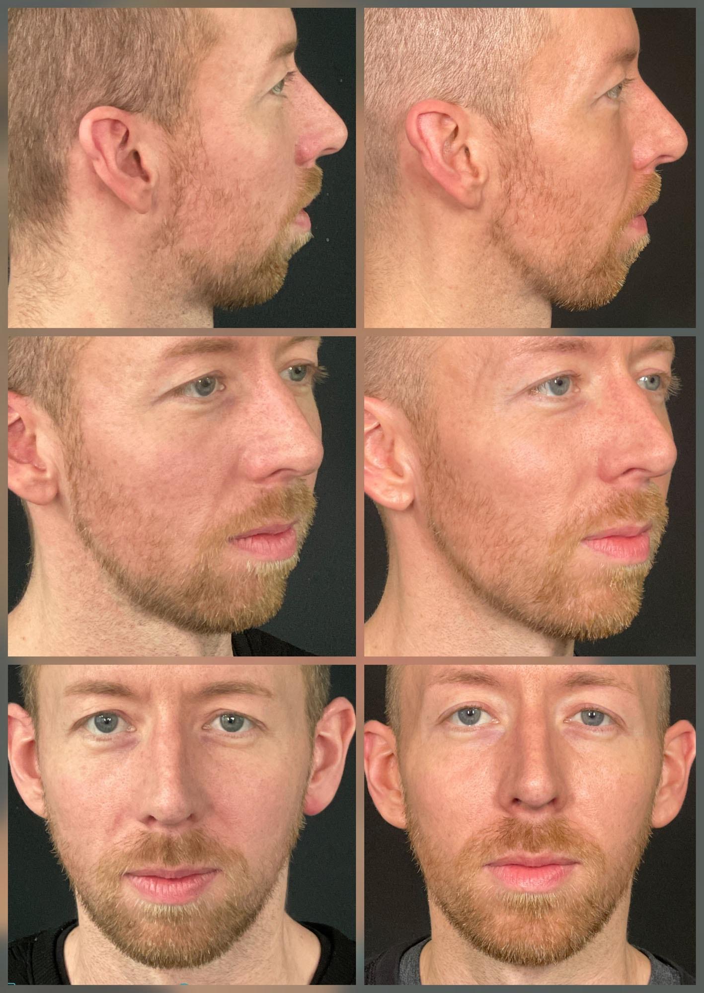 ReFresh Aesthetic Center jawline filler result — Mequon, WI