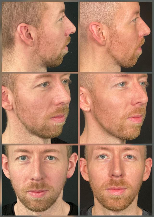 Jawline Filler result at ReFresh Aesthetic Center in Mequon, WI