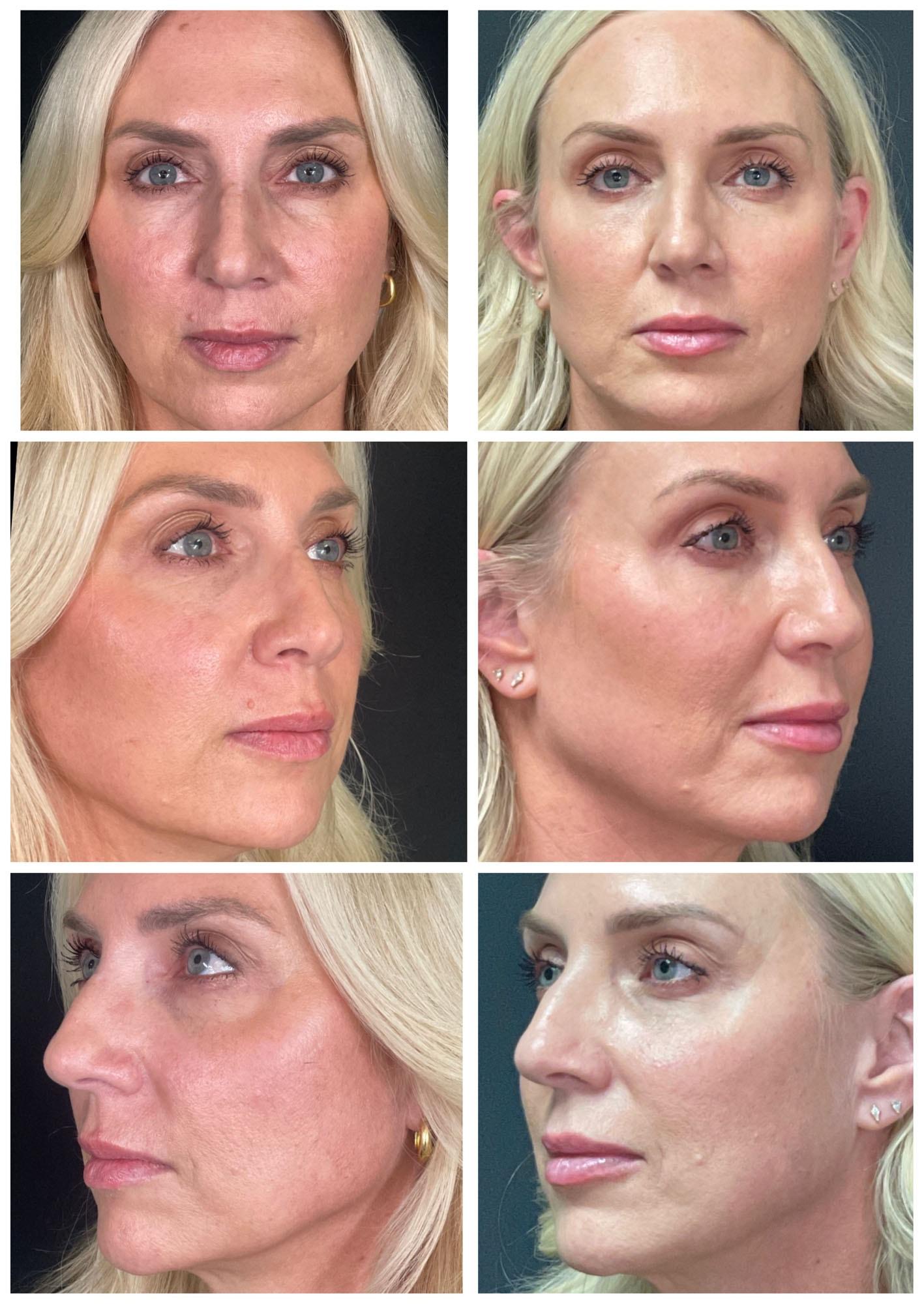 ReFresh Aesthetic Center cheek filler result — Mequon, WI