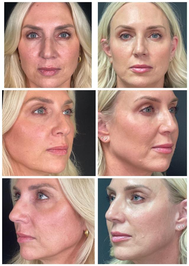 Juvederm result at ReFresh Aesthetic Center in Mequon, WI