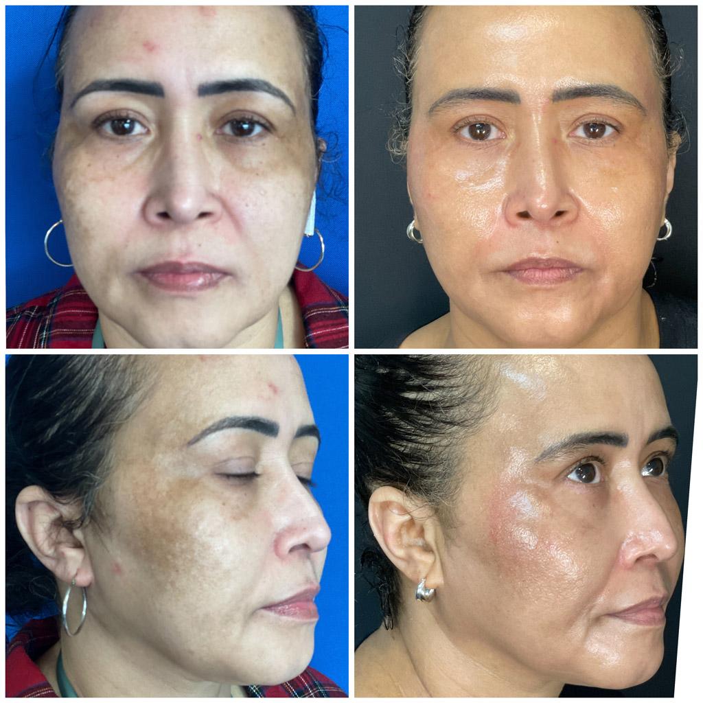 ReFresh Aesthetic Center result — Mequon, WI