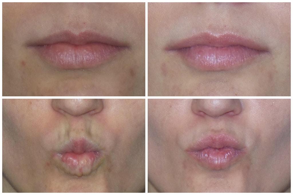 ReFresh Aesthetic Center botox result — Mequon, WI