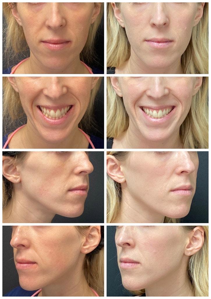 ReFresh Aesthetic Center cheek filler result — Mequon, WI