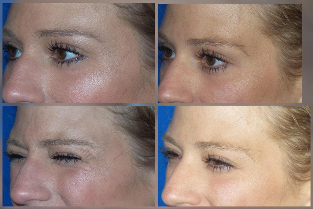 ReFresh Aesthetic Center botox result — Mequon, WI