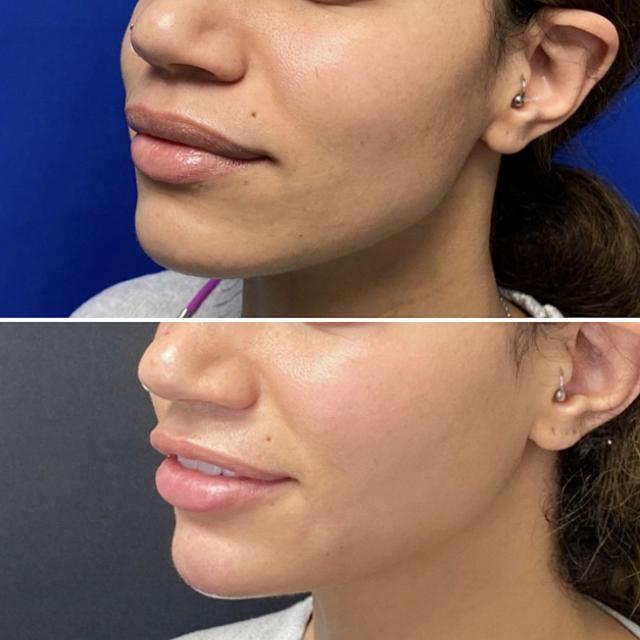 Lip Filler result at ReFresh Aesthetic Center in Mequon, WI