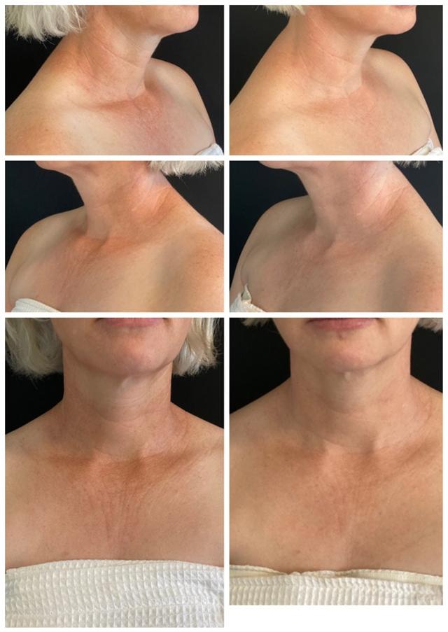Chemical Peel result at ReFresh Aesthetic Center in Mequon, WI