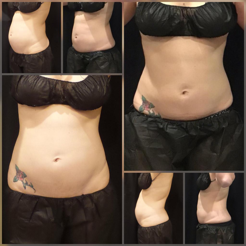 ReFresh Aesthetic Center coolsculpting result — Mequon, WI