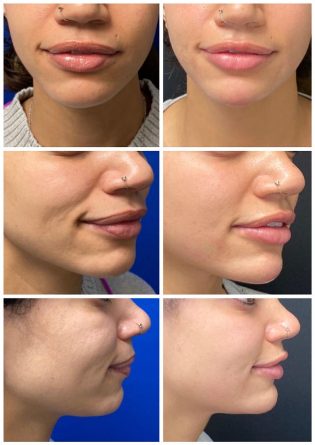 Jawline Filler result at ReFresh Aesthetic Center in Mequon, WI