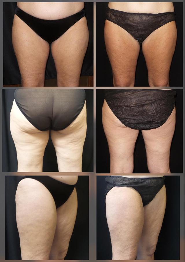 CoolSculpting result at ReFresh Aesthetic Center in Mequon, WI
