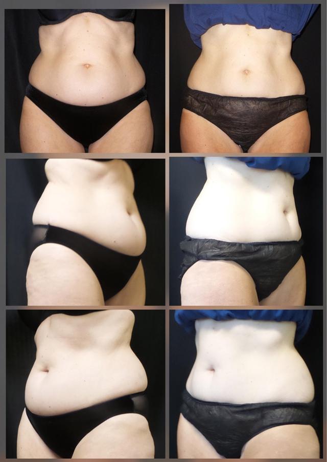 CoolSculpting result at ReFresh Aesthetic Center in Mequon, WI