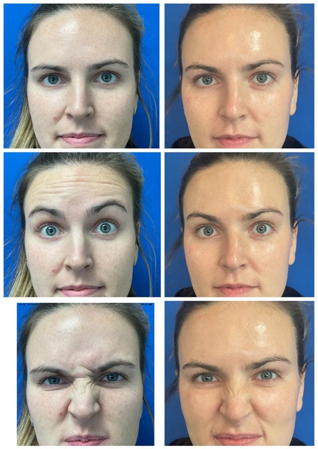 Botox result at ReFresh Aesthetic Center in Mequon, WI