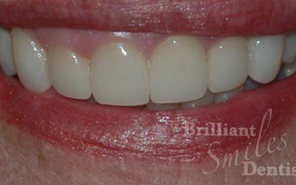 Brilliant Smiles Dentistry dental crowns after — Scottsdale, AZ