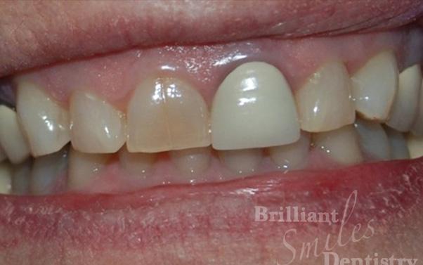 Gum Contouring before at Brilliant Smiles Dentistry in Scottsdale, AZ