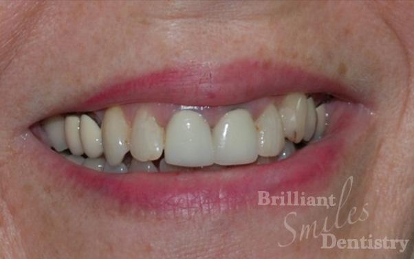 Dental Veneers before at Brilliant Smiles Dentistry in Scottsdale, AZ