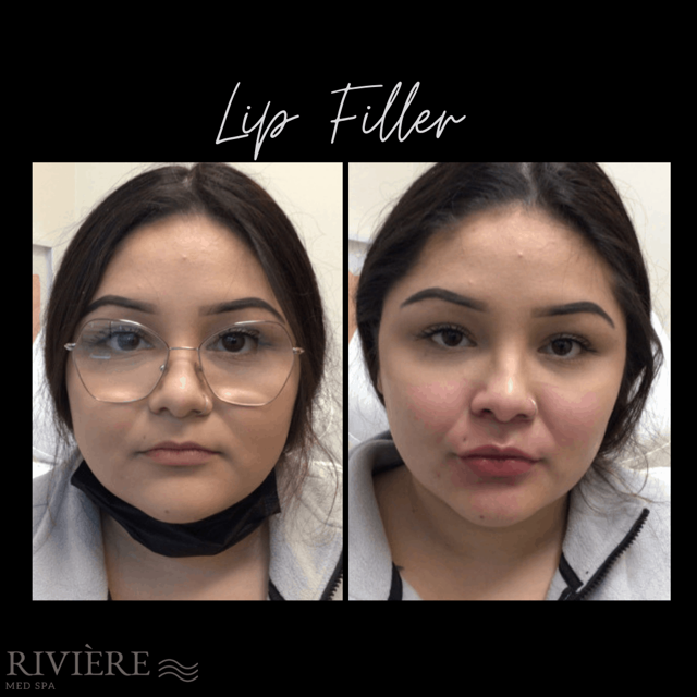 Lip Filler result at Rivière Med Spa in Portland, OR