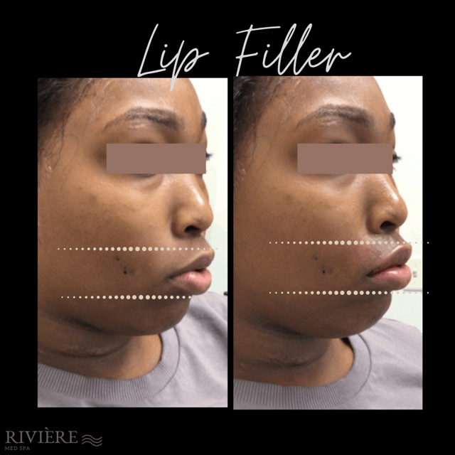 Lip Filler result at Rivière Med Spa in Portland, OR