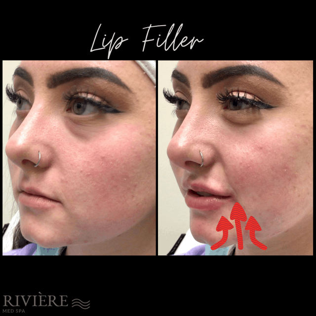 Lip Filler result at Rivière Med Spa in Portland, OR