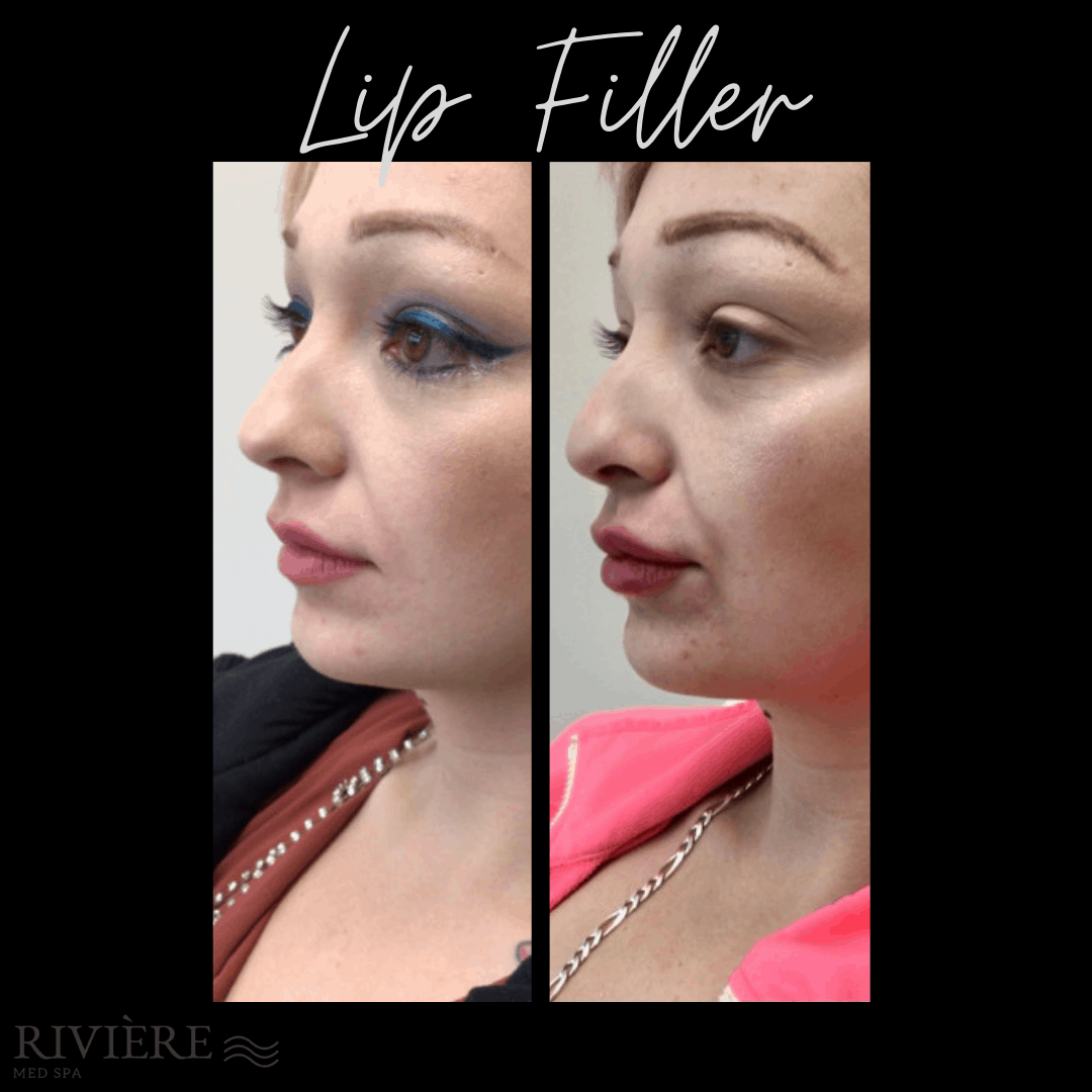 Rivière Med Spa lip filler result — Portland, OR