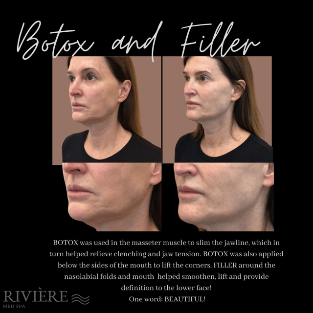 Lip Filler result at Rivière Med Spa in Portland, OR