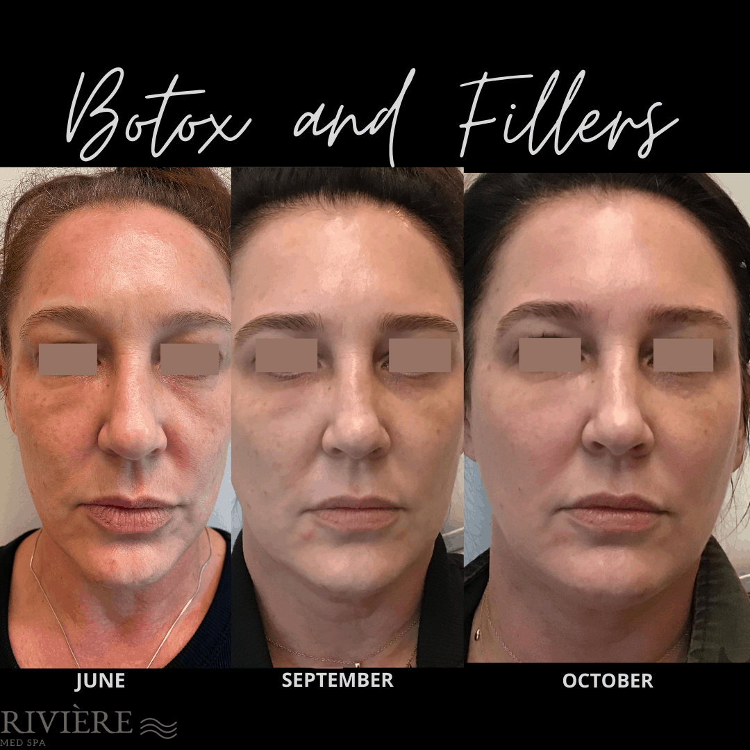 Rivière Med Spa botox result — Portland, OR