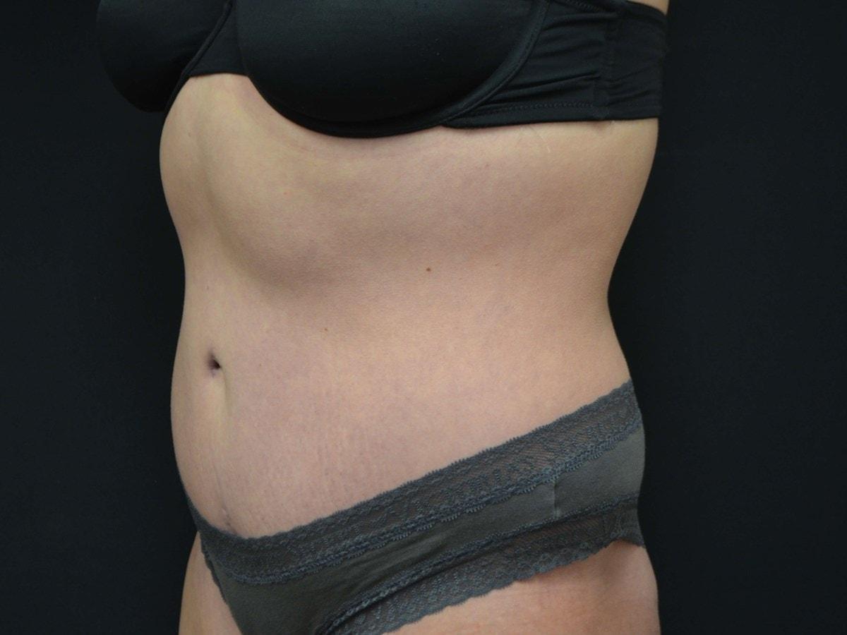 Kouris M.D. Cosmetic Plastic Surgery tummy tuck after — Hinsdale, IL