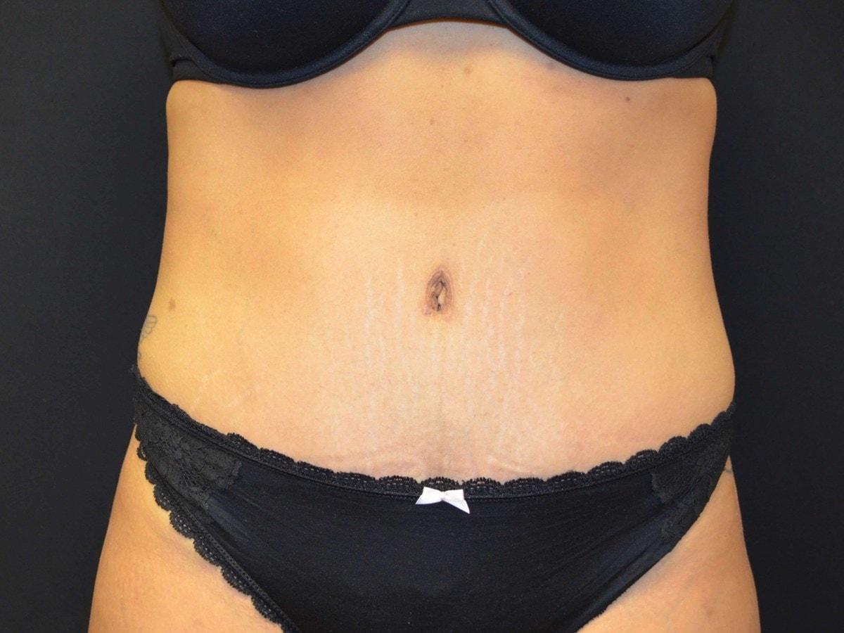 Kouris M.D. Cosmetic Plastic Surgery tummy tuck after — Hinsdale, IL