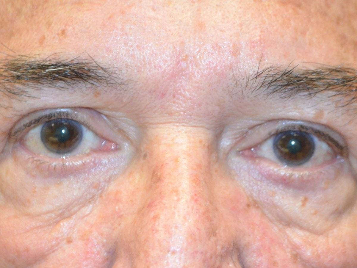 Kouris M.D. Cosmetic Plastic Surgery eyelid lift after — Hinsdale, IL