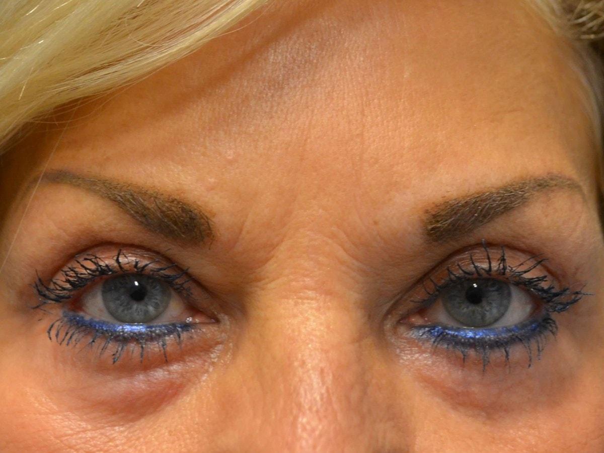 Kouris M.D. Cosmetic Plastic Surgery eyelid lift after — Hinsdale, IL