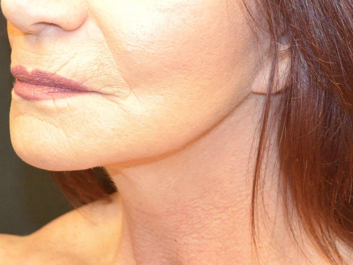 Kouris M.D. Cosmetic Plastic Surgery facelift after — Hinsdale, IL