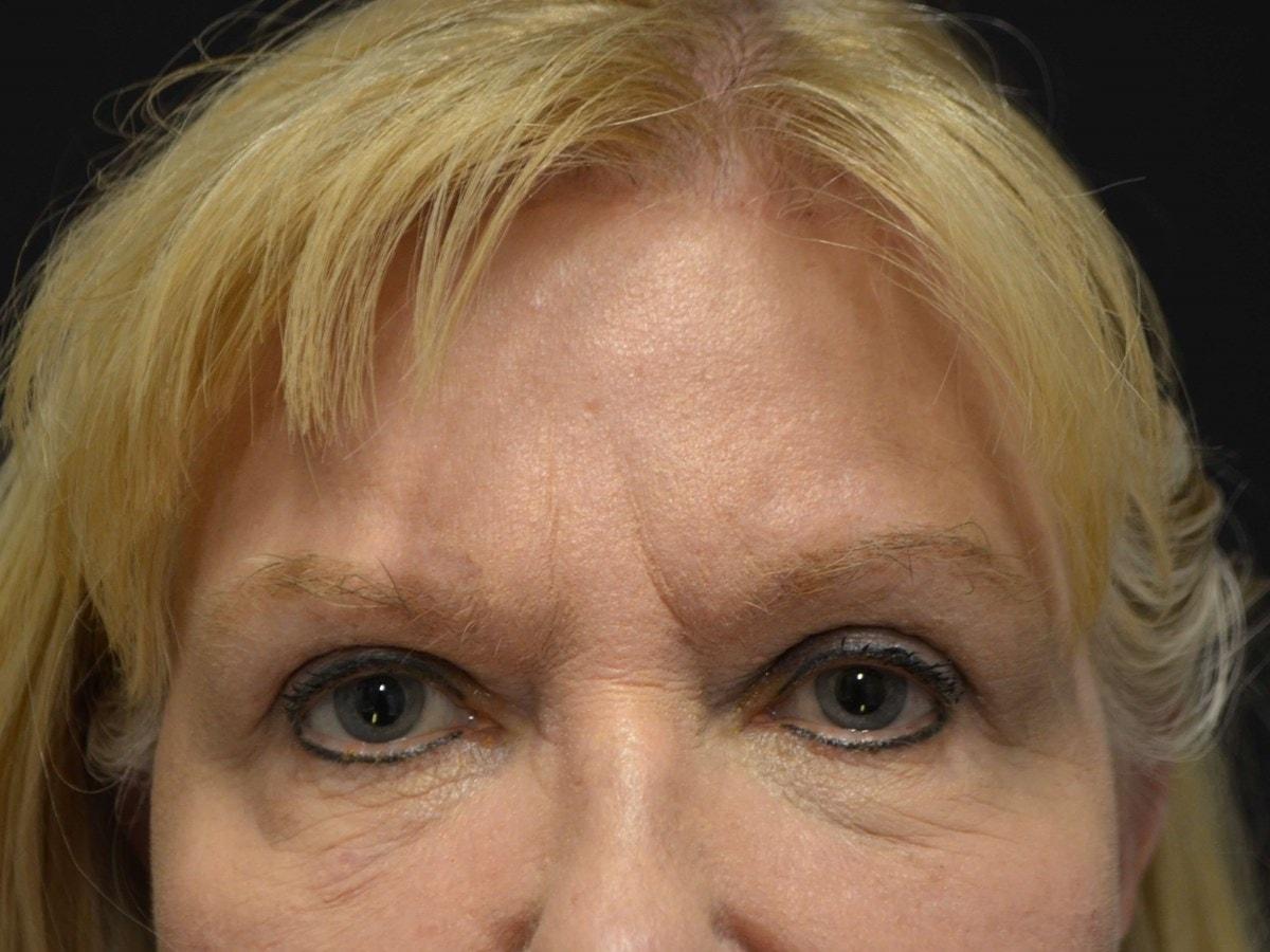 Kouris M.D. Cosmetic Plastic Surgery eyelid lift after — Hinsdale, IL