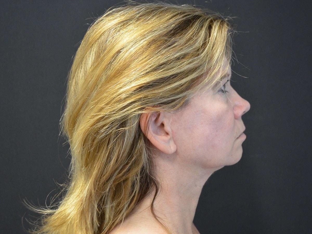 Kouris M.D. Cosmetic Plastic Surgery facelift after — Hinsdale, IL