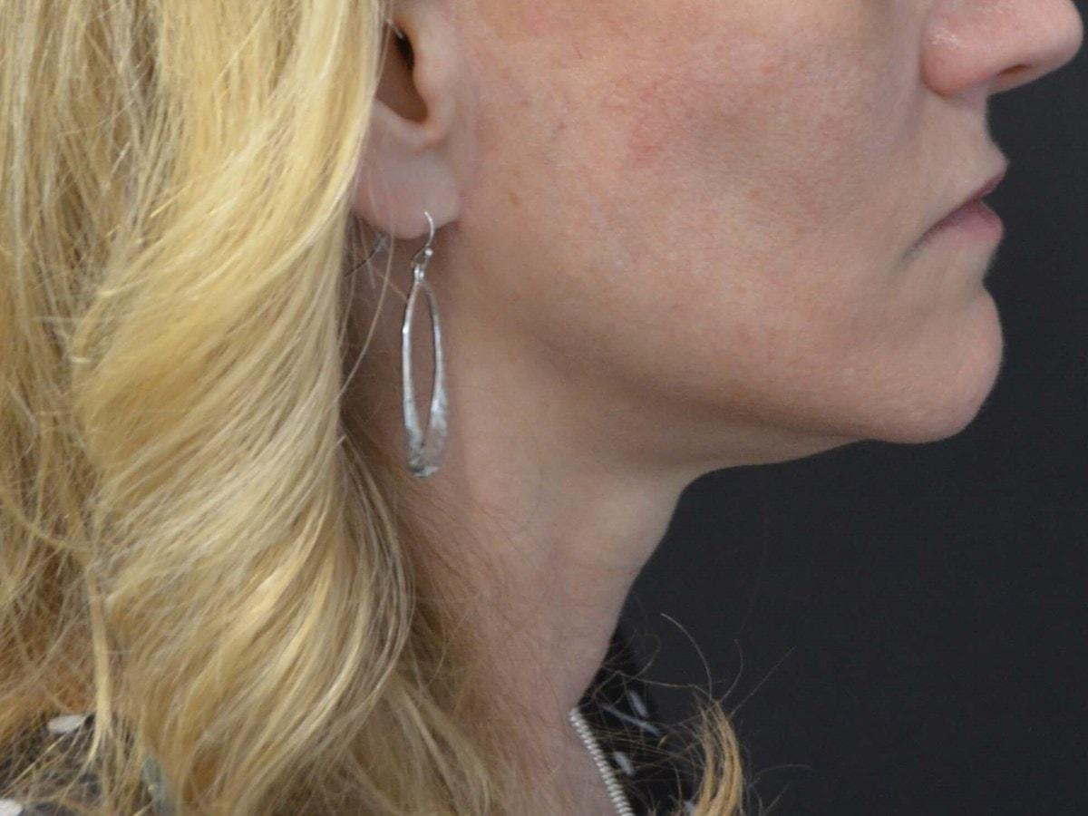 Kouris M.D. Cosmetic Plastic Surgery facelift after — Hinsdale, IL